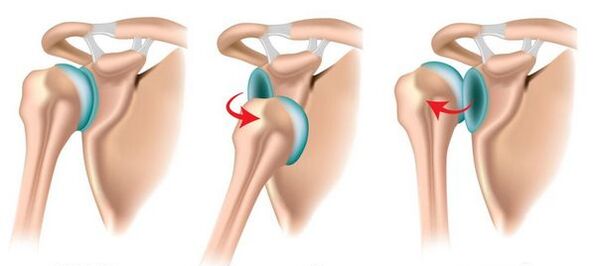 Anterior and posterior dislocation of the shoulder joint, provoking the development of arthrosis