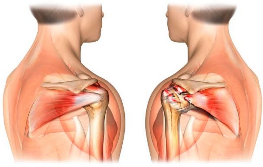 Healthy shoulder affected by arthrosis