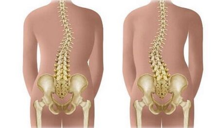 Not resistant scoliosis