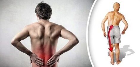 Pain syndrome with lumbar osteochondosis radiates to the legs