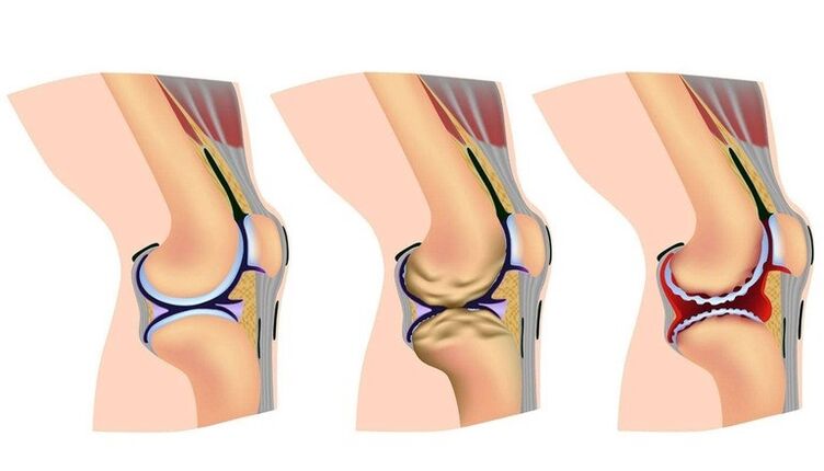Deformation phase in the knee joint for arthrosis