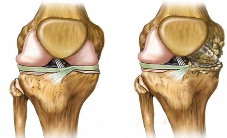 Healthy and impressed by the arthrosis joint