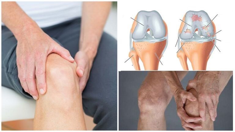 Symptom of knee pain of the arthrosis of the knee joint