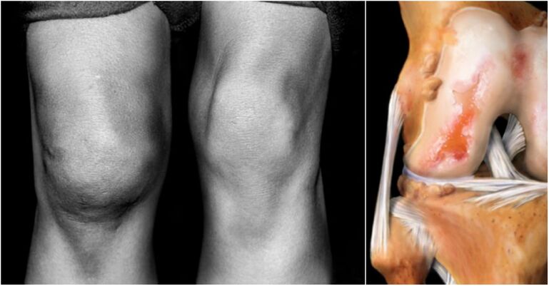 arthrosis of the joint of the knee and dozen
