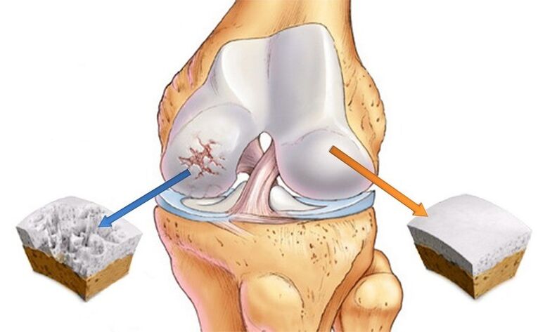 normal cartilage and struck by osteoarthritis