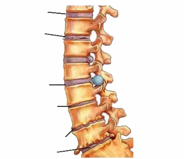 Damage to the spine leads to back pain