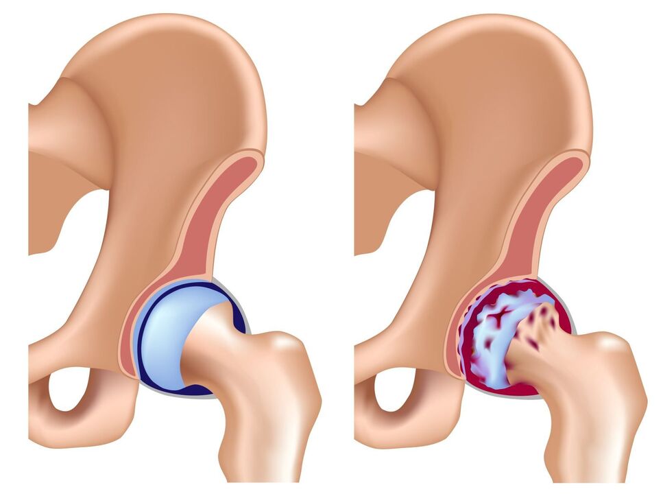 comparison between a healthy joint and arthrosis