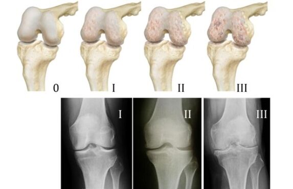 Methods for diagnosing knee osteoarthritis