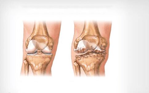 arthrosis of the knee joint