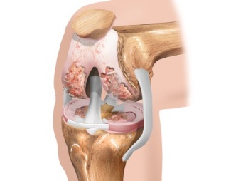 the pattern of osteoarthritis